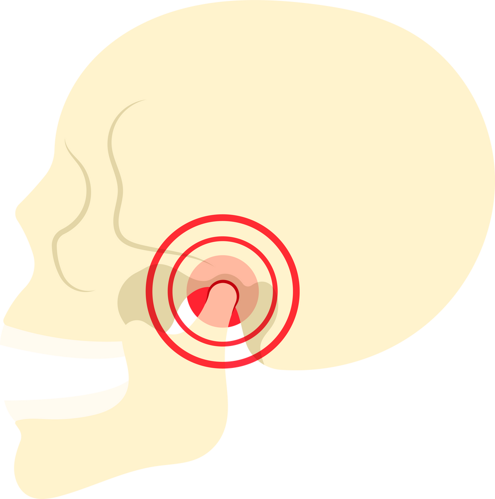 Temporomandibular disorder jaw maxillofacial orthodontic mandible facial dysfunction Orthognatic injury chewing stress skull bone face mandibular TMJ TMD Joint pain syndrome overbite underbite